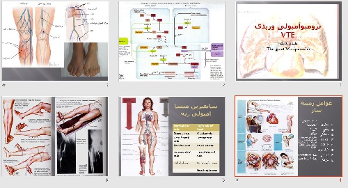 ترومبو آمبولی وریدی(VTE) (ppt) 20 اسلاید